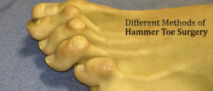 Different Methods Of Hammer Toe Surgery: LondonFootandAnkleSurgery.co.uk