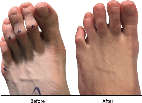 hammer toe surgery