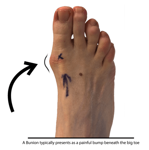 Bunion - Foot Problem