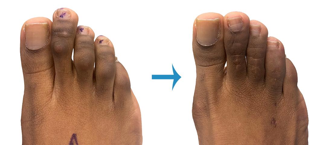 Hammer Toe Before And After Surgery