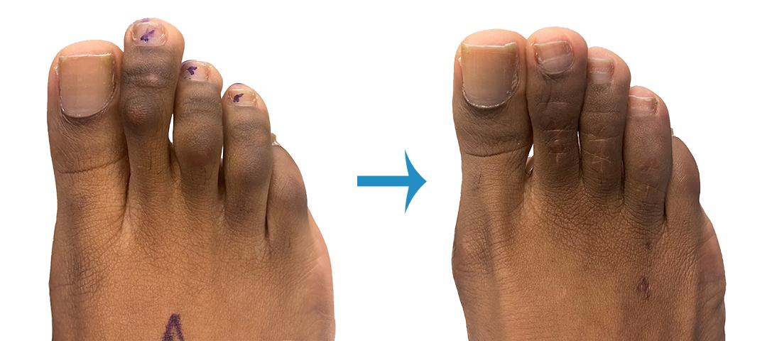 Toe Shortening Surgery Uk