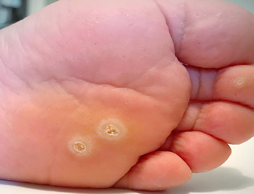 Wart under foot