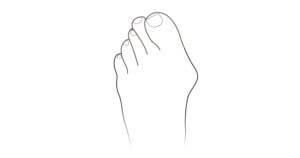 Bunions