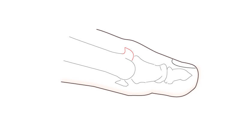 Hallux Rigidus Surgery-Cheilectomy Procedure Details