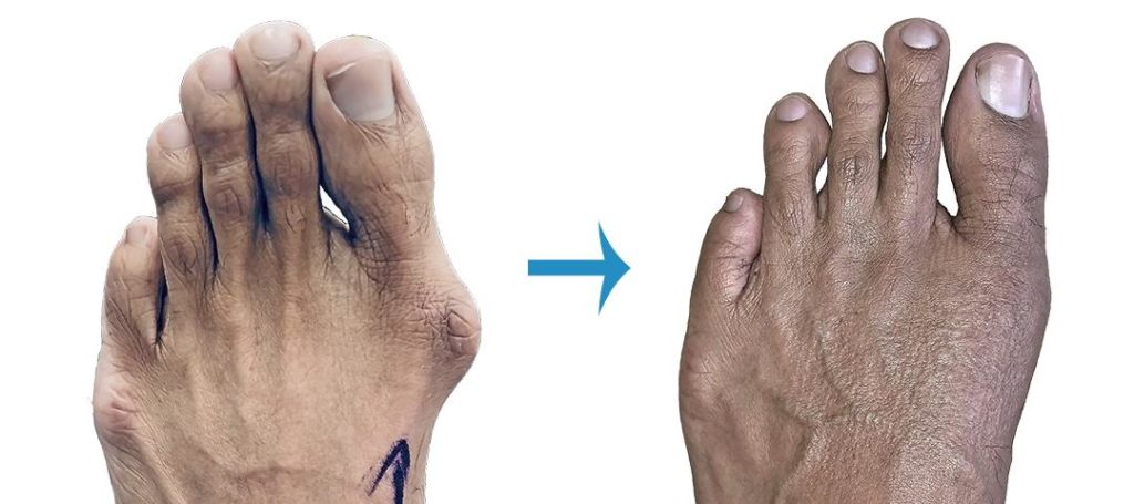 bunion ankle