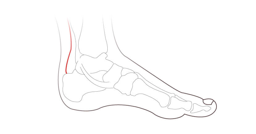 Foot Conditions - Achilles Tendon Rupture