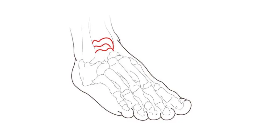 Ankle Arthritis Surgery visual guide
