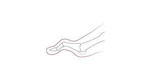 Plantar Plate Injury