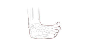 Ankle Injury