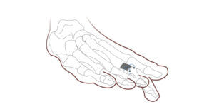 Plantar Plate Repair Surgery