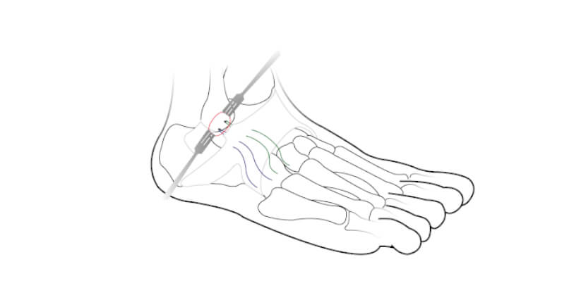 Ankle Injury Surgery - Broström procedure