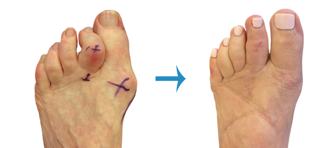 Before And After Foot Surgery - Image Gallery | London Foot & Ankle Surgery