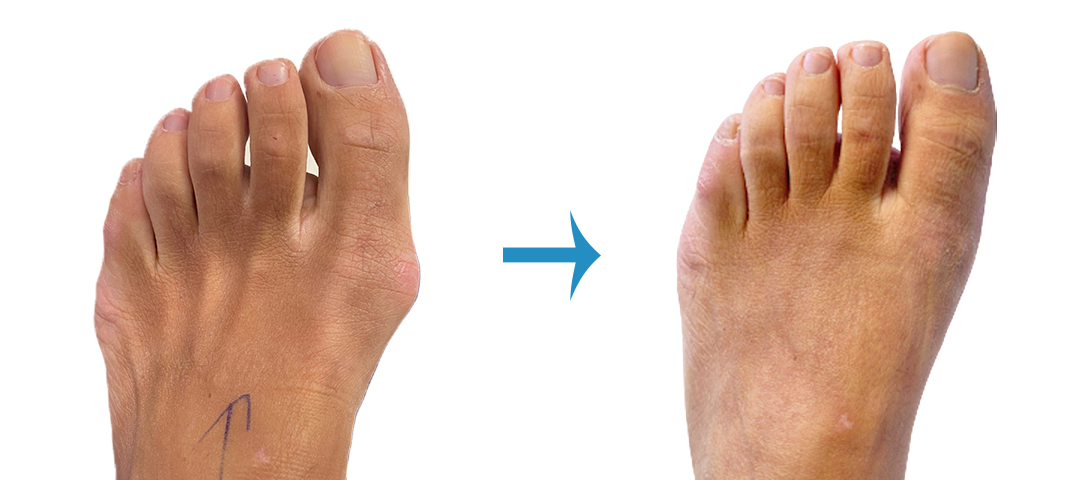 Before And After Foot Surgery - Image Gallery | London Foot & Ankle Surgery