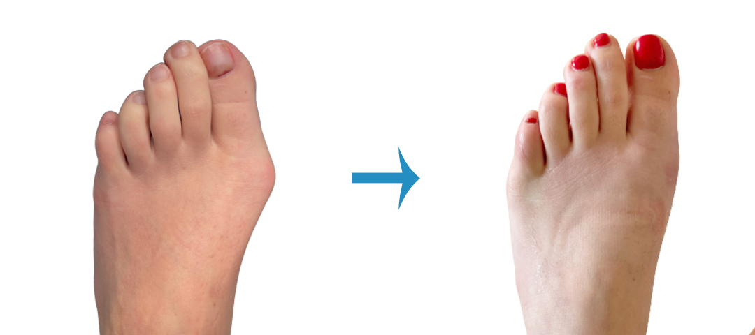 Before and after picture of bunion correction