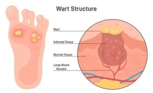 Wart Structure What is a verruca