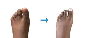 Hammertoe Surgery
