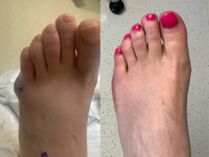 Before and After Tailor’s Bunion Surgery