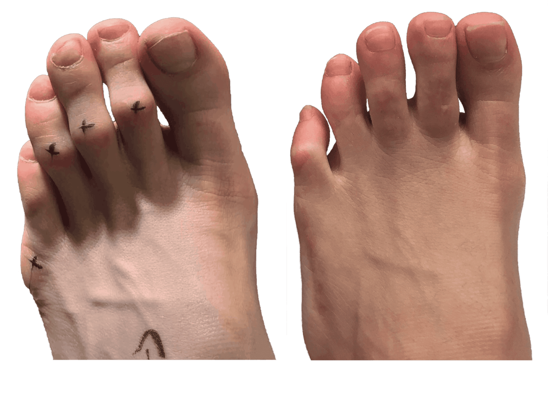 Before-After-Hammertoe-1-scaled (1) (2) (1) Before-After-Hammertoe