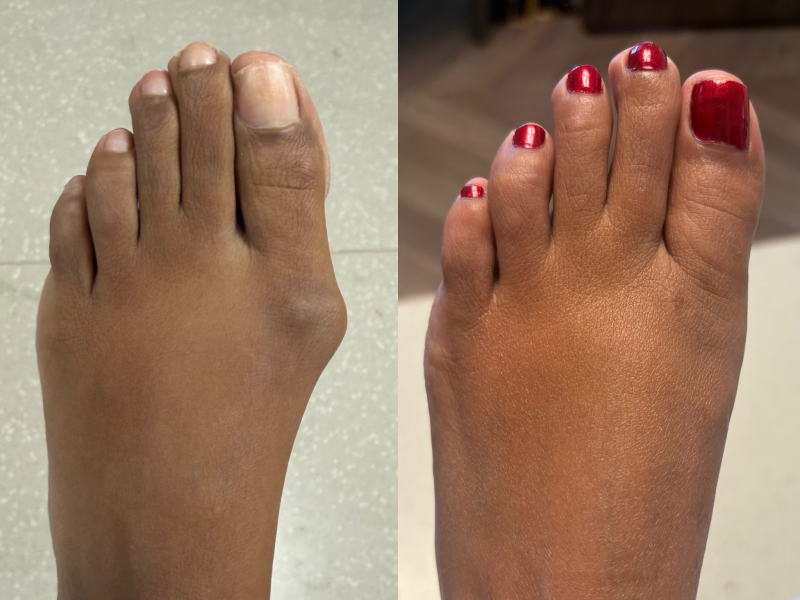 What is the Success Rate of Bunion Surgery? Results, Recurrence and Risks What is the Success Rate of Bunion Surgery? Results, Recurrence and Risks